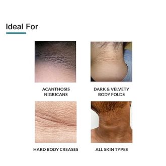Fixderma Nigrifix cream for Acanthosis Nigricans | For Dark Body Parts Like Neck, Knuckles, Armpits, Ankles, Thighs, Elbows | Exfoliant- 100g - Image 4