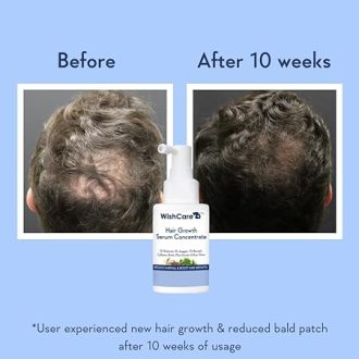 WishCare Hair Growth Serum Concentrate - 3% Redensyl, 4% Anagain, 2% Baicapil, Caffeine, Biotin, Plant Keratin & Rice Water - Hair Growth Serum for Men & Women - Image 2
